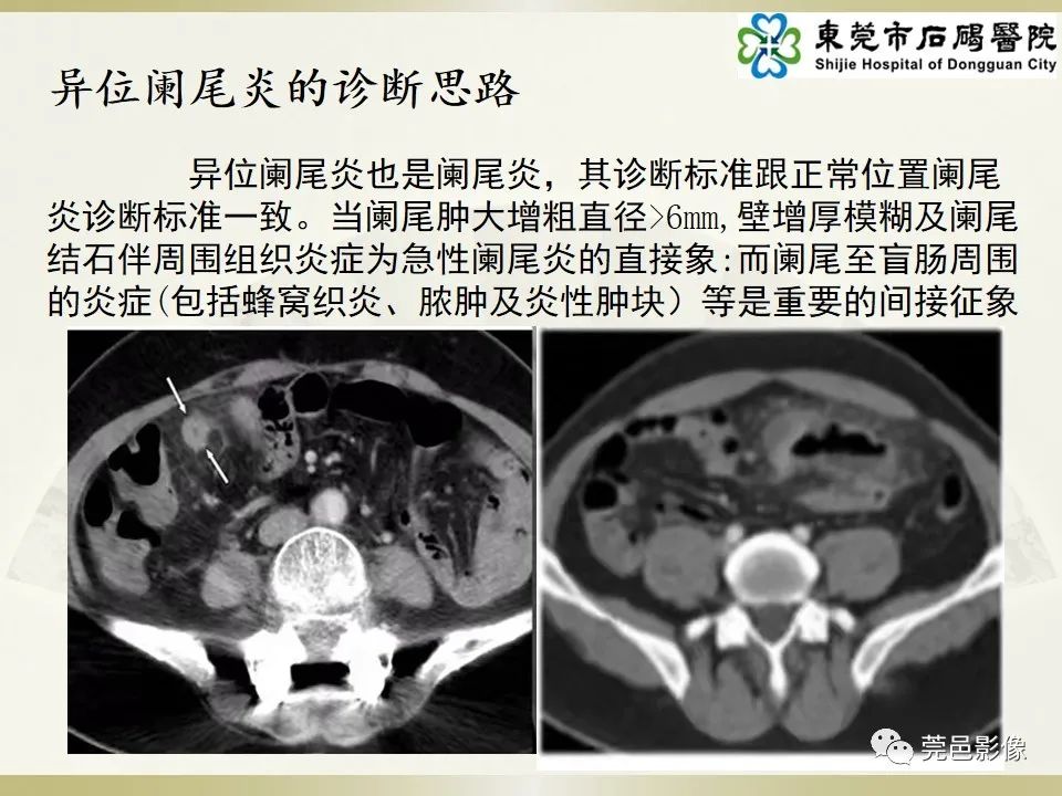 影像PPT - 【PPT】异位阑尾炎的CT诊断-16