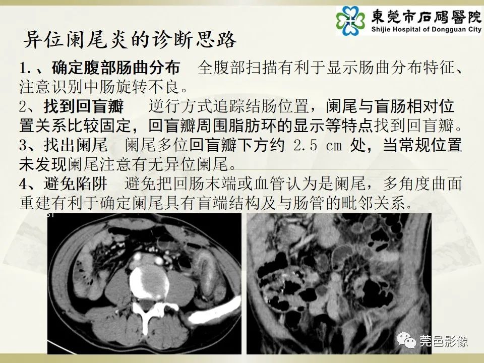 影像PPT - 【PPT】异位阑尾炎的CT诊断-17