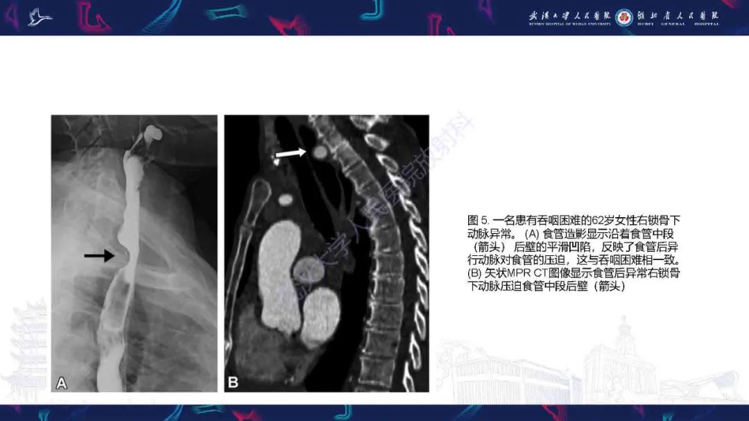 影像PPT - 【PPT】锁骨下动脉正常解剖及病变影像诊断-9