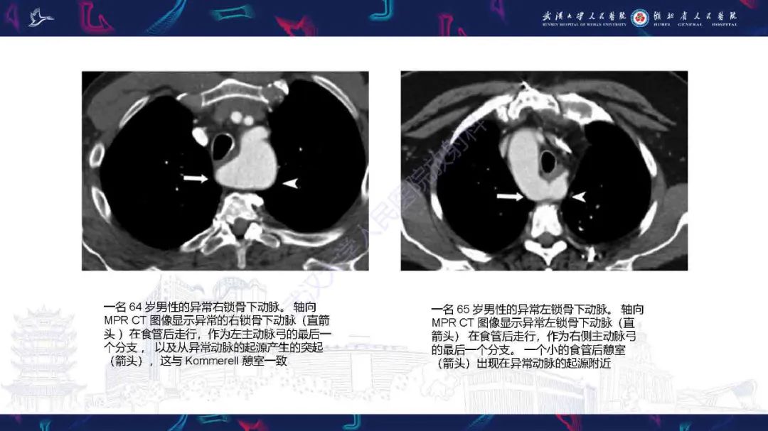影像PPT - 【PPT】锁骨下动脉正常解剖及病变影像诊断-10