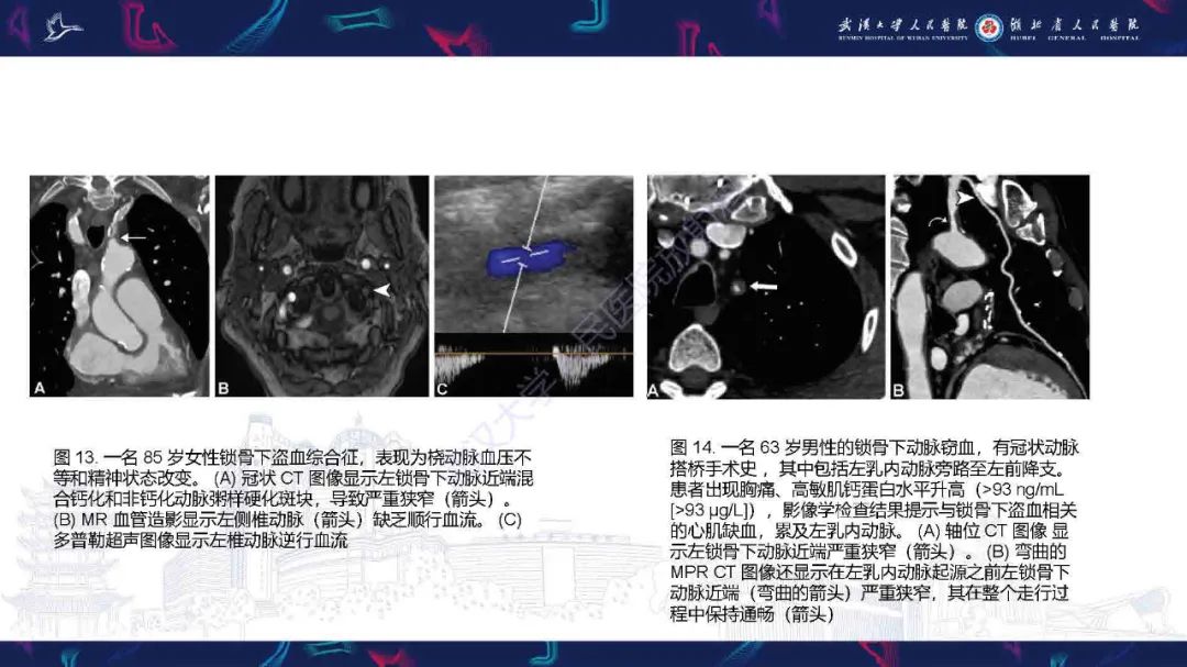 影像PPT - 【PPT】锁骨下动脉正常解剖及病变影像诊断-20