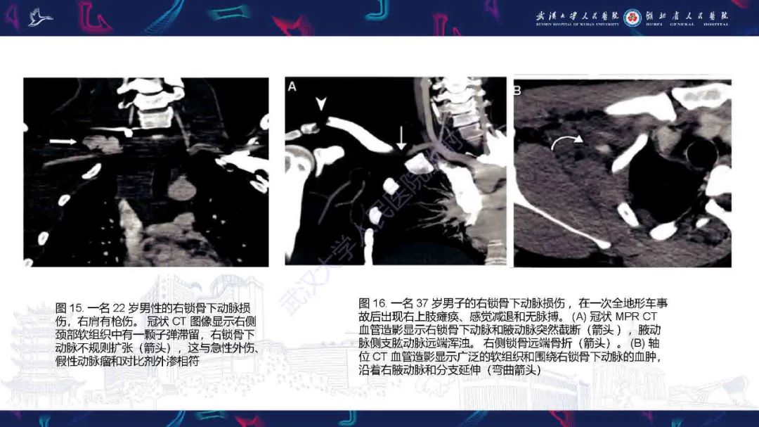 影像PPT - 【PPT】锁骨下动脉正常解剖及病变影像诊断-22