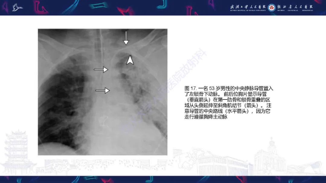 影像PPT - 【PPT】锁骨下动脉正常解剖及病变影像诊断-23