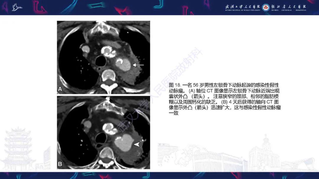 影像PPT - 【PPT】锁骨下动脉正常解剖及病变影像诊断-25