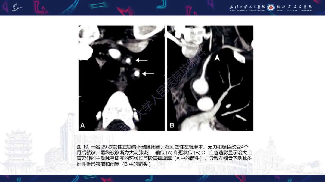 影像PPT - 【PPT】锁骨下动脉正常解剖及病变影像诊断-27