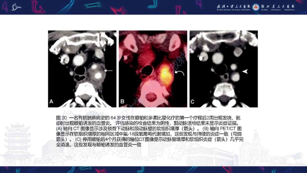 影像PPT - 【PPT】锁骨下动脉正常解剖及病变影像诊断-28