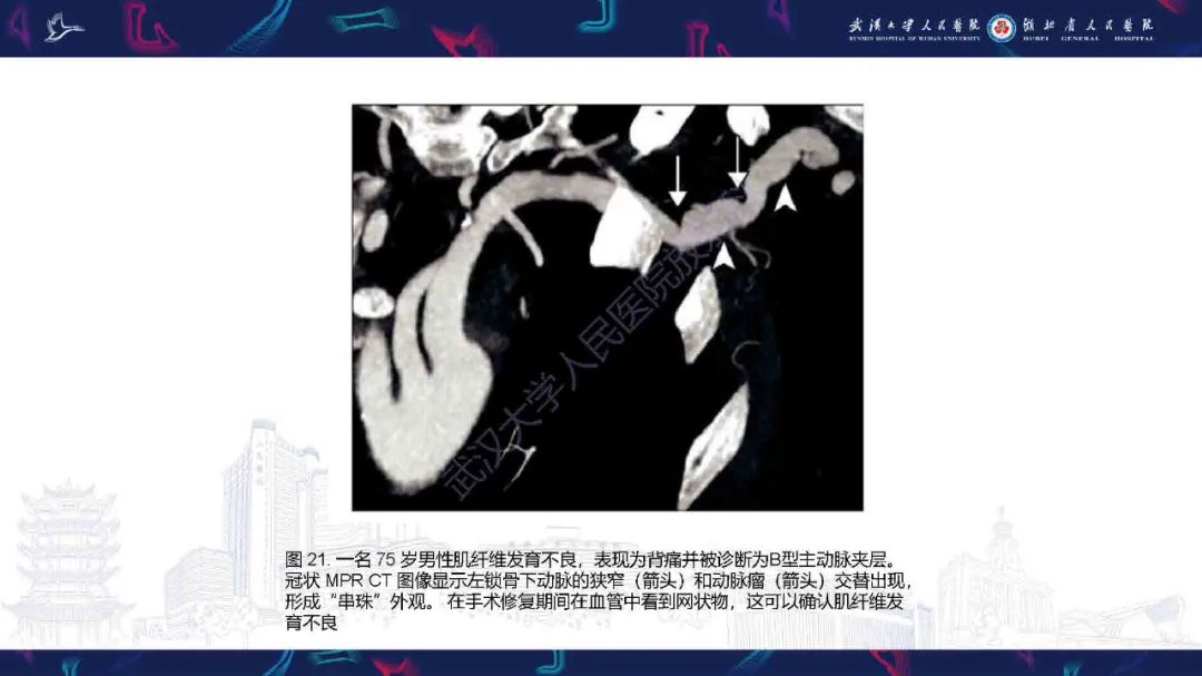 影像PPT - 【PPT】锁骨下动脉正常解剖及病变影像诊断-30