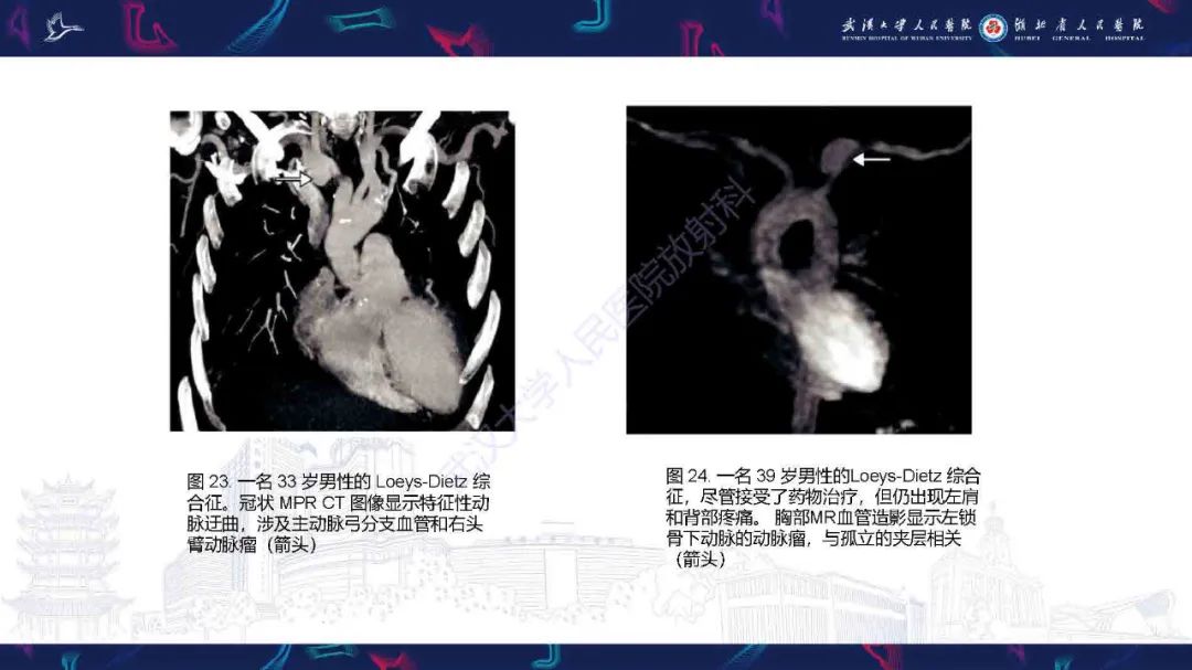 影像PPT - 【PPT】锁骨下动脉正常解剖及病变影像诊断-33
