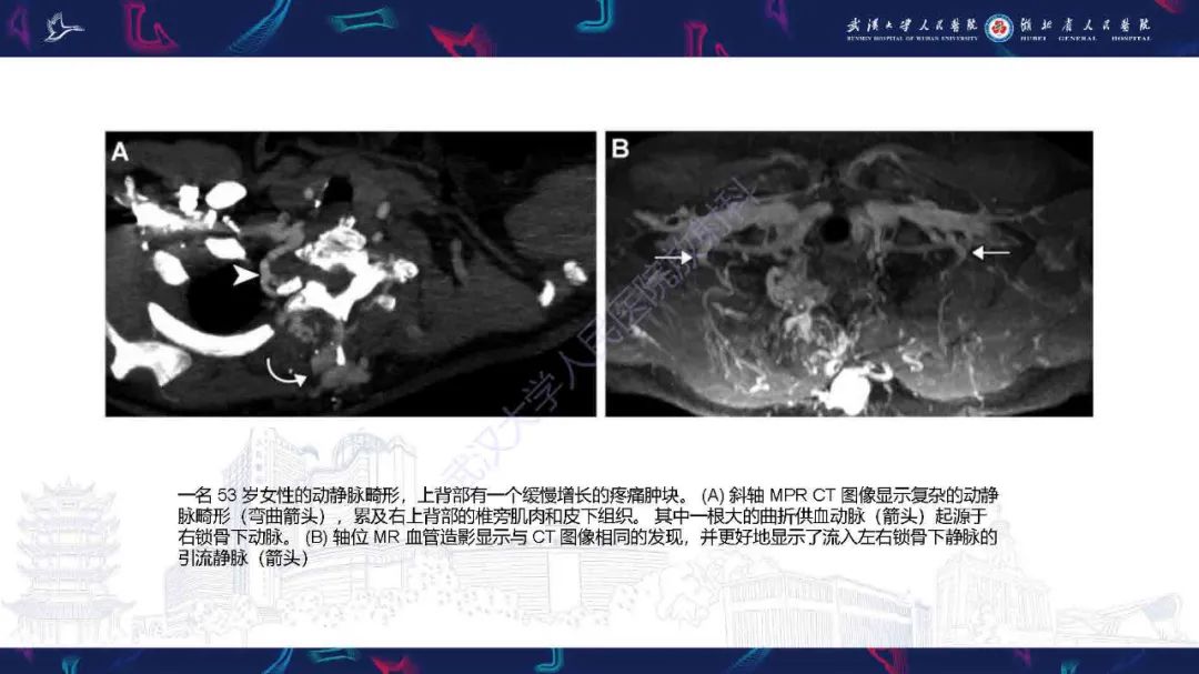 影像PPT - 【PPT】锁骨下动脉正常解剖及病变影像诊断-37