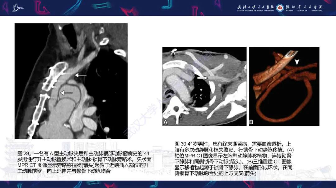 影像PPT - 【PPT】锁骨下动脉正常解剖及病变影像诊断-40