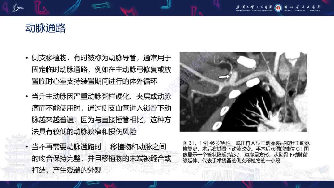 影像PPT - 【PPT】锁骨下动脉正常解剖及病变影像诊断-41