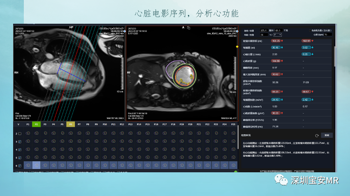 影像PPT - 【PPT】新冠病毒相关心肌炎的磁共振诊断-11