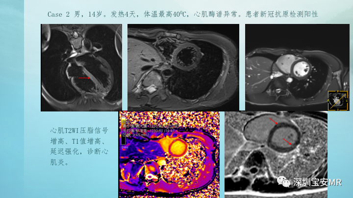 影像PPT - 【PPT】新冠病毒相关心肌炎的磁共振诊断-13