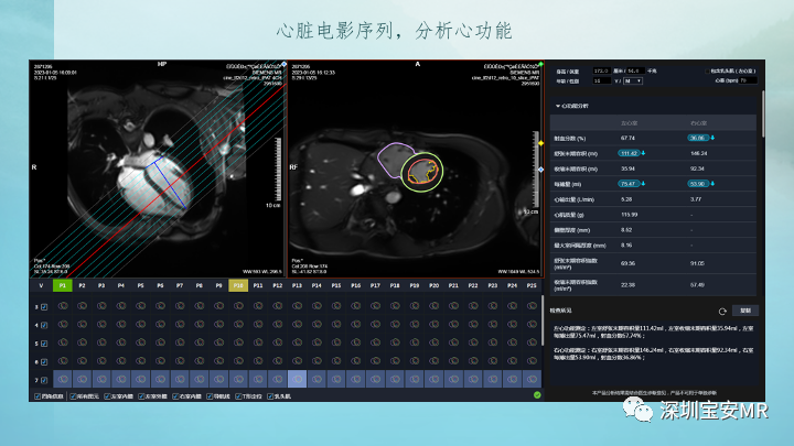 影像PPT - 【PPT】新冠病毒相关心肌炎的磁共振诊断-14