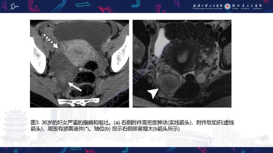 影像PPT - 【PPT】附件扭转影像诊断-18