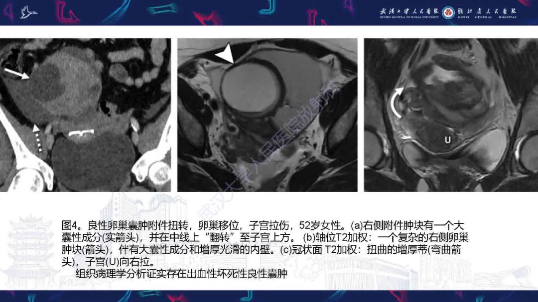 影像PPT - 【PPT】附件扭转影像诊断-20