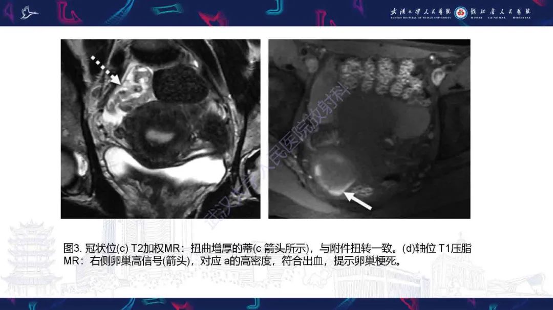 影像PPT - 【PPT】附件扭转影像诊断-19