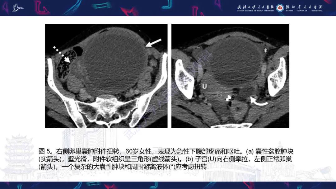 影像PPT - 【PPT】附件扭转影像诊断-21