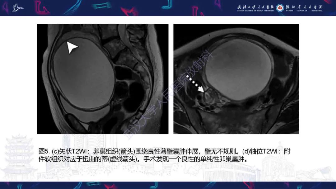 影像PPT - 【PPT】附件扭转影像诊断-22