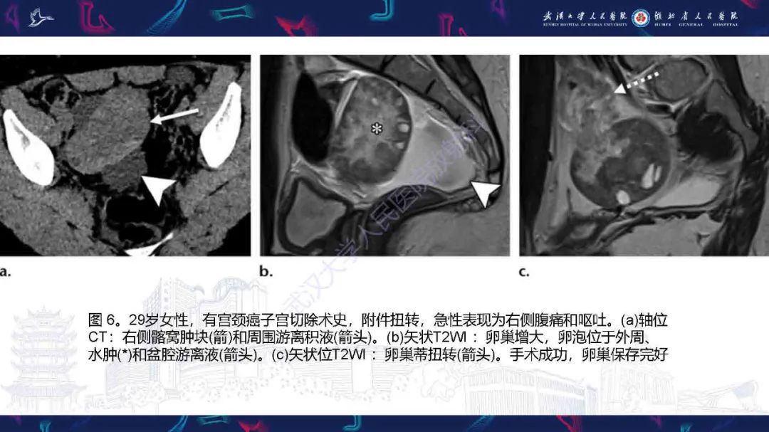 影像PPT - 【PPT】附件扭转影像诊断-23