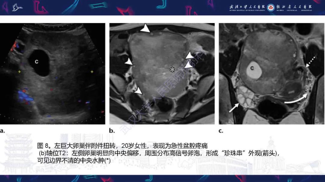 影像PPT - 【PPT】附件扭转影像诊断-24