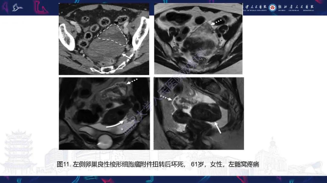 影像PPT - 【PPT】附件扭转影像诊断-26