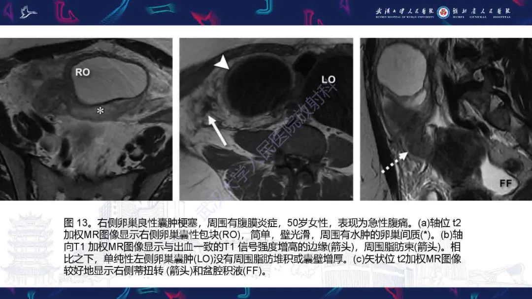影像PPT - 【PPT】附件扭转影像诊断-28