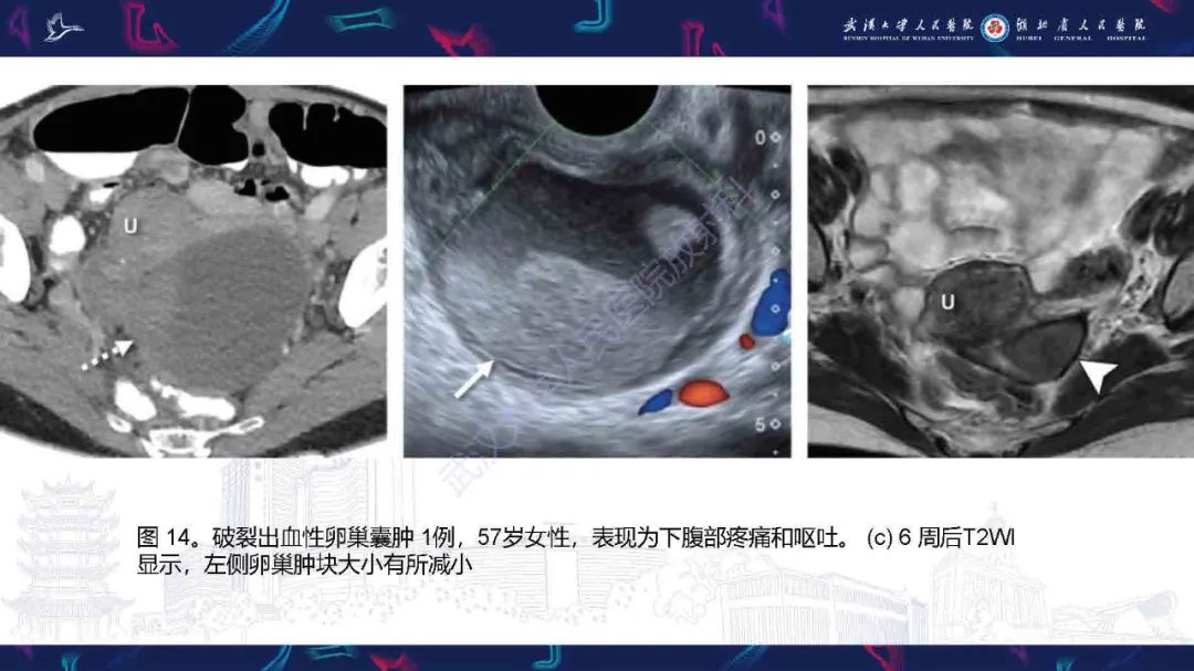 影像PPT - 【PPT】附件扭转影像诊断-29