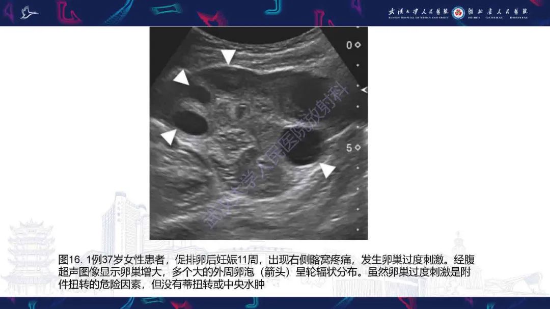 影像PPT - 【PPT】附件扭转影像诊断-31