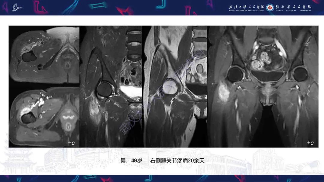 影像PPT - 【PPT】骨化性肌炎影像诊断-3