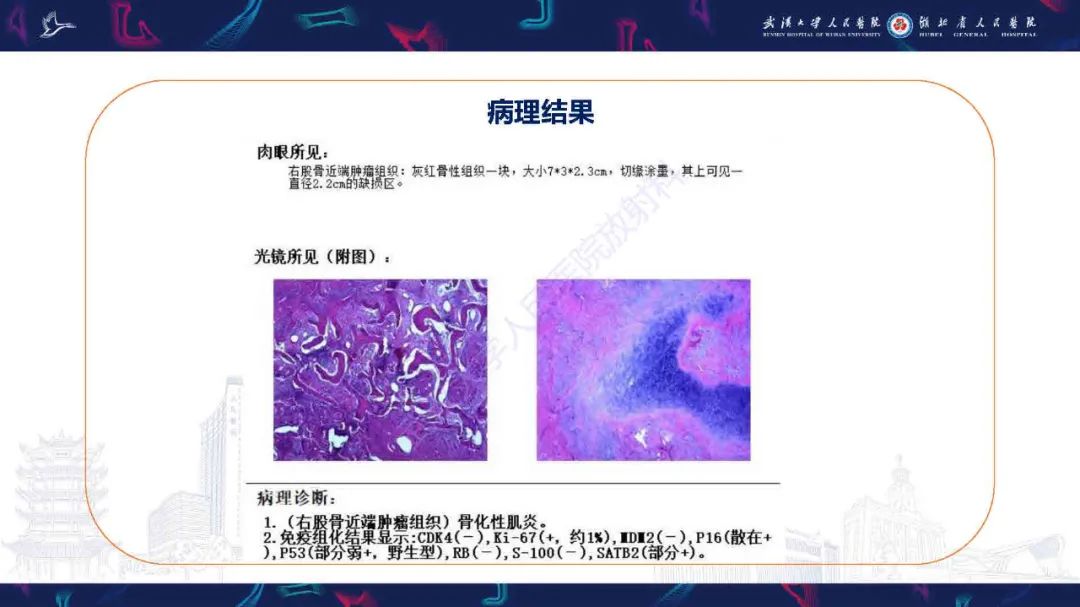 影像PPT - 【PPT】骨化性肌炎影像诊断-5