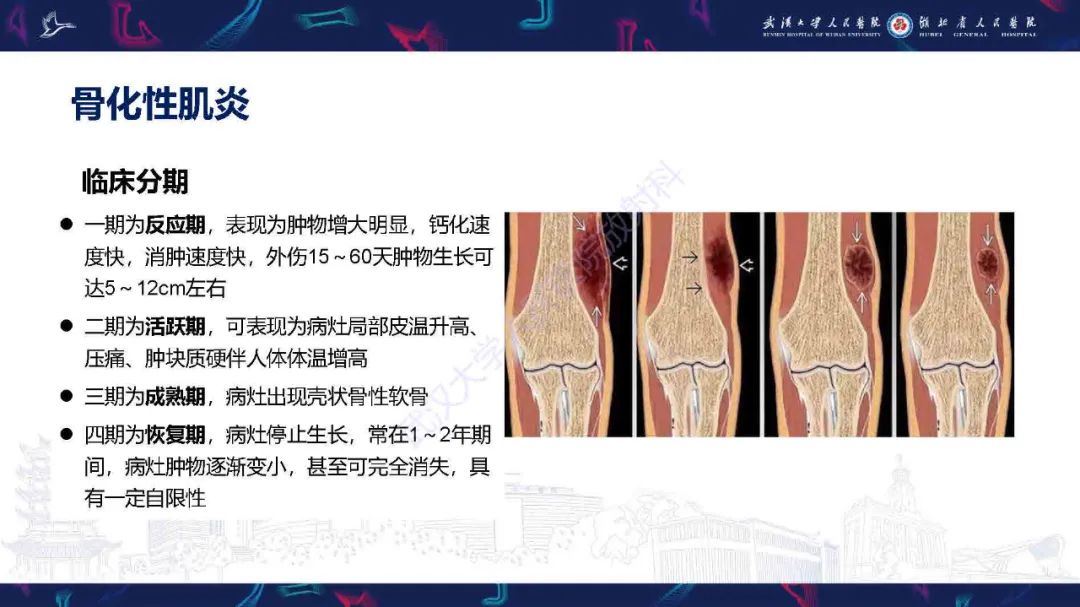 影像PPT - 【PPT】骨化性肌炎影像诊断-7
