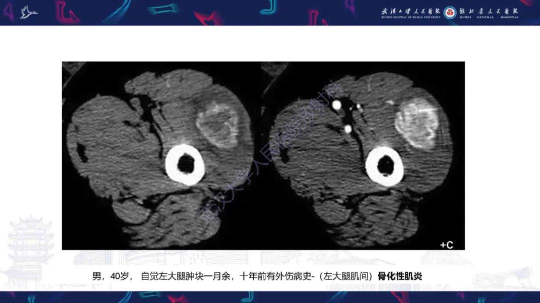 影像PPT - 【PPT】骨化性肌炎影像诊断-10