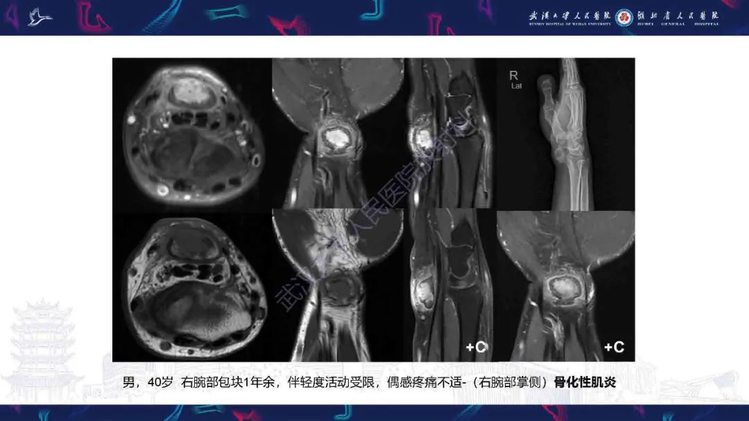 影像PPT - 【PPT】骨化性肌炎影像诊断-11