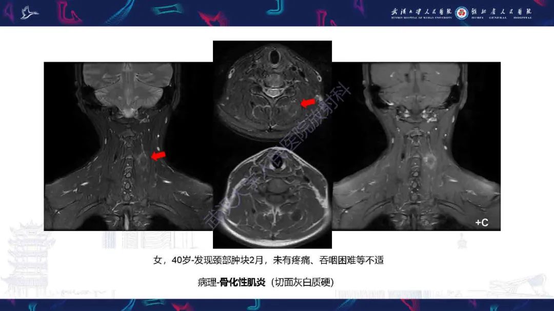 影像PPT - 【PPT】骨化性肌炎影像诊断-14
