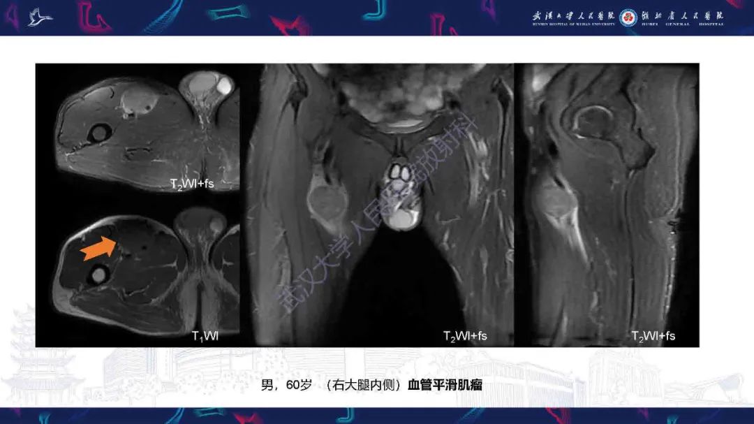 影像PPT - 【PPT】骨化性肌炎影像诊断-17