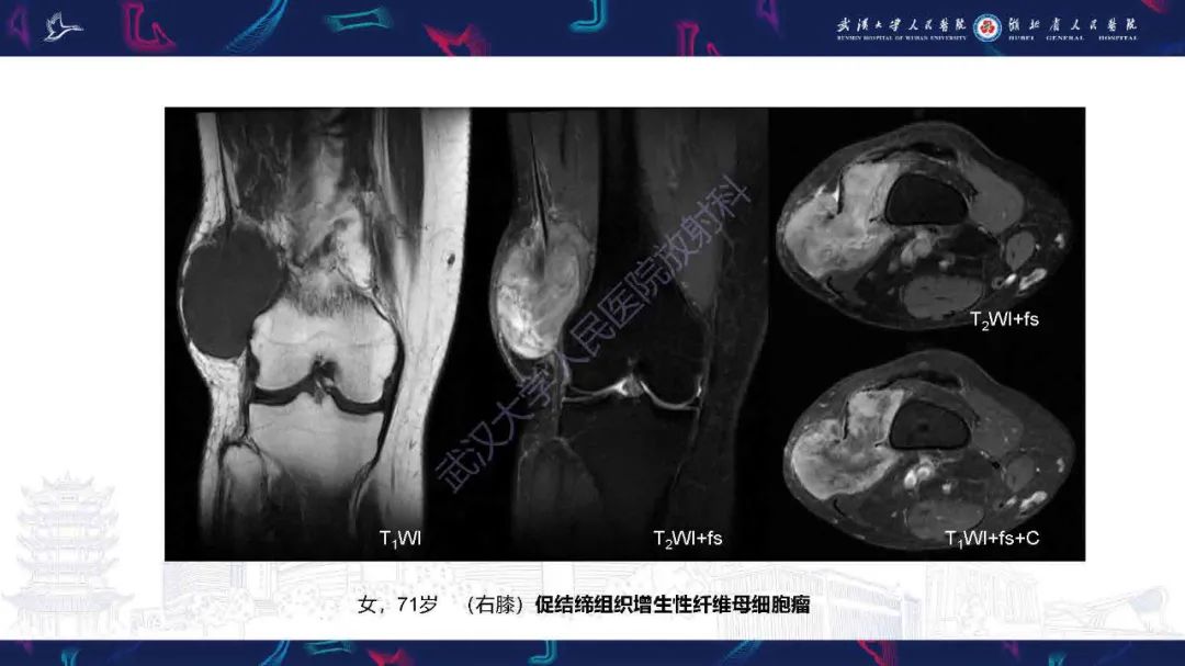 影像PPT - 【PPT】骨化性肌炎影像诊断-18