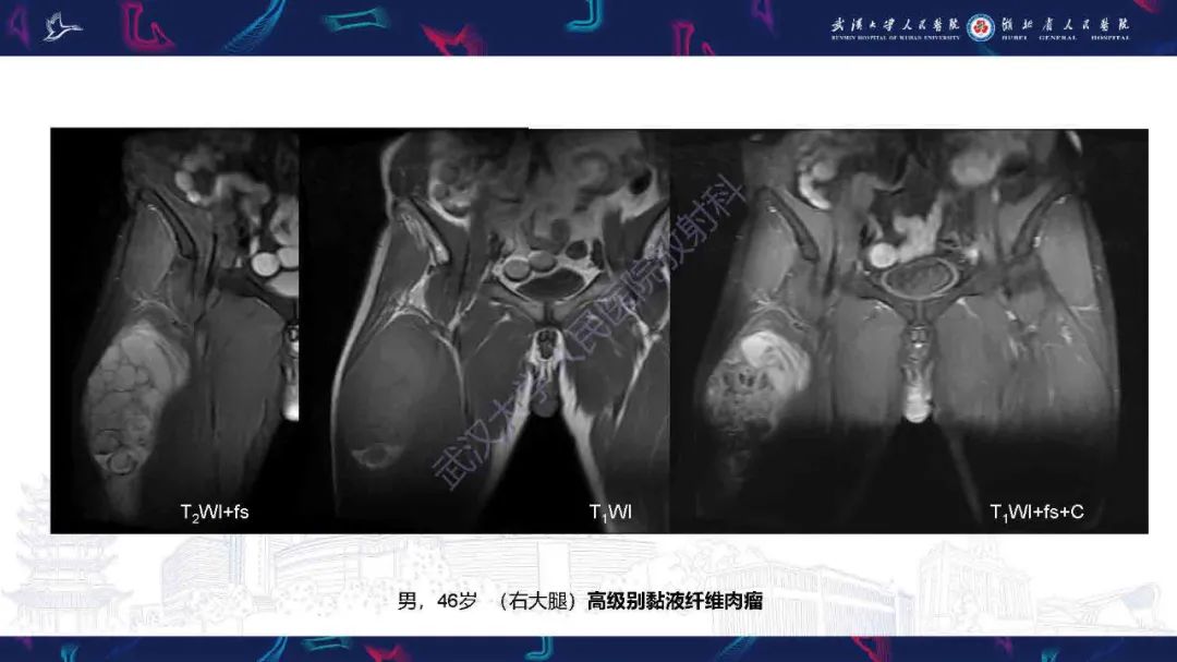 影像PPT - 【PPT】骨化性肌炎影像诊断-19