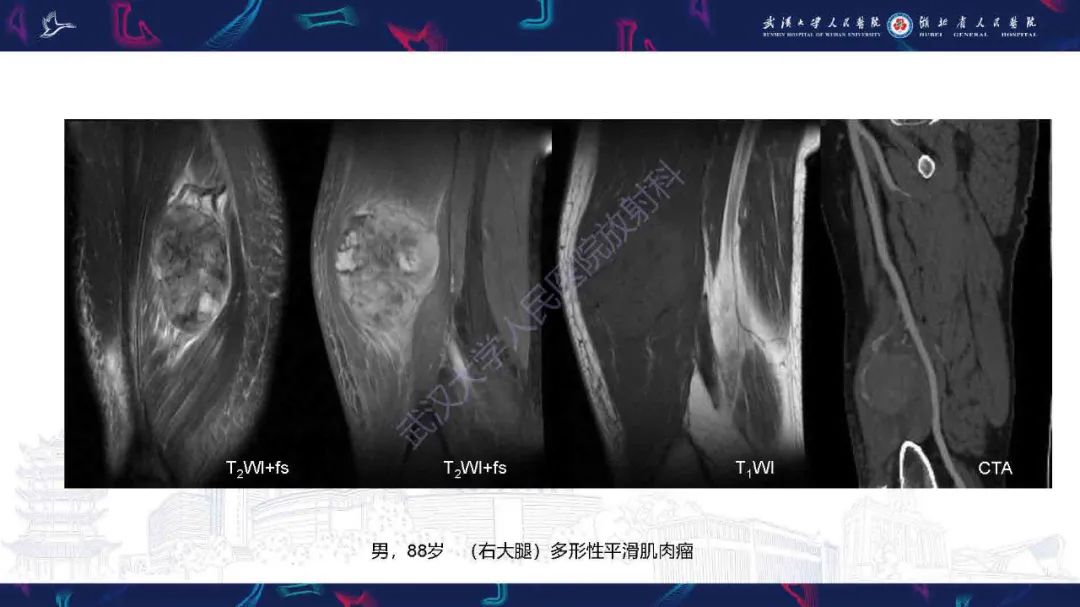 影像PPT - 【PPT】骨化性肌炎影像诊断-20