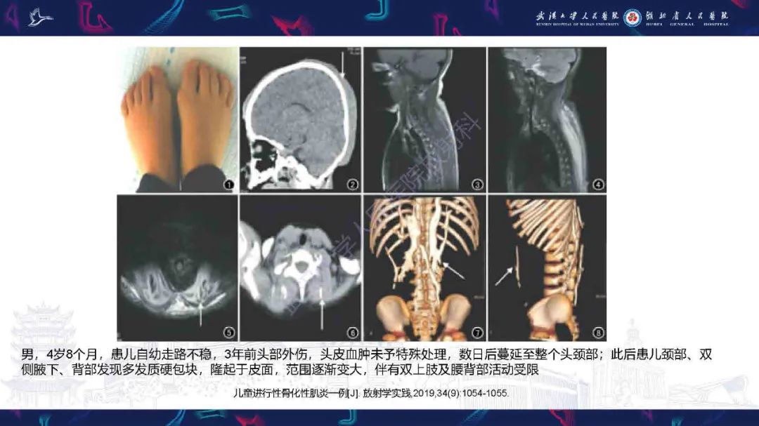 影像PPT - 【PPT】骨化性肌炎影像诊断-23