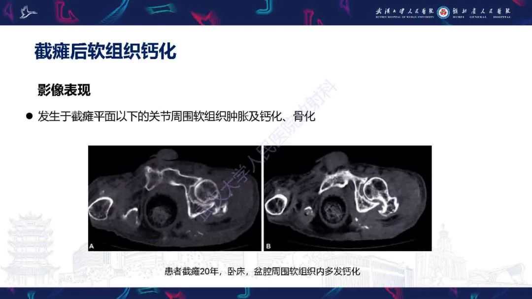影像PPT - 【PPT】骨化性肌炎影像诊断-25