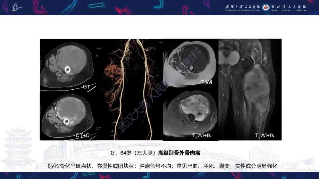 影像PPT - 【PPT】骨化性肌炎影像诊断-27