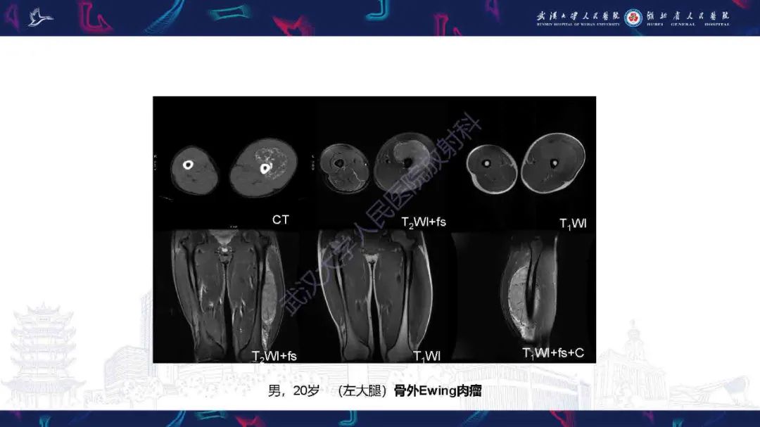 影像PPT - 【PPT】骨化性肌炎影像诊断-28