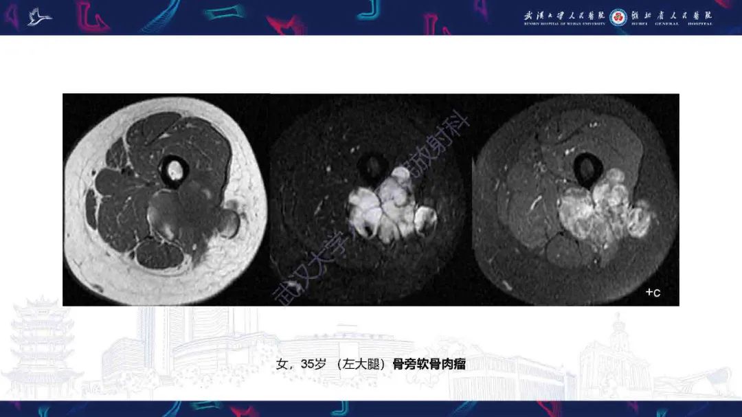影像PPT - 【PPT】骨化性肌炎影像诊断-29