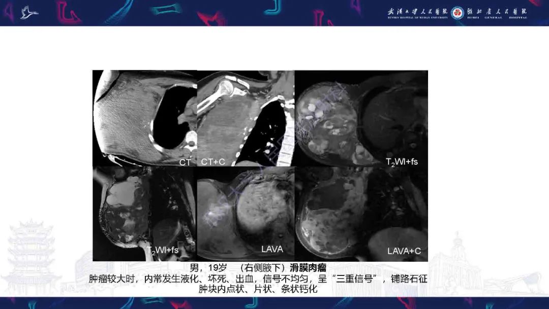 影像PPT - 【PPT】骨化性肌炎影像诊断-30