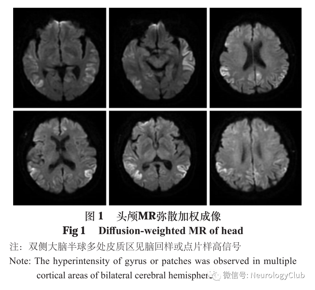 影像PPT - 脑皮质层状坏死的研究进展-1 影像PPT - 脑皮质层状坏死的研究进展-1