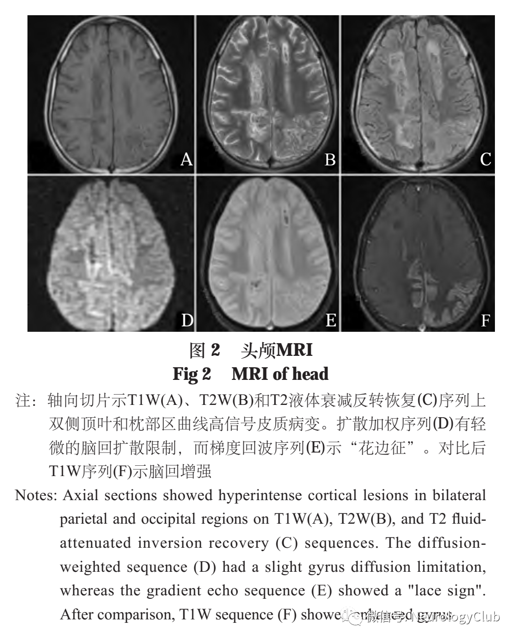 影像PPT - 脑皮质层状坏死的研究进展-2 影像PPT - 脑皮质层状坏死的研究进展-2