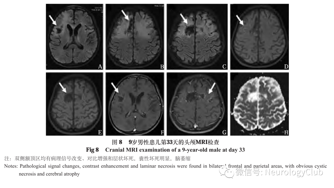 影像PPT - 脑皮质层状坏死的研究进展-8 影像PPT - 脑皮质层状坏死的研究进展-8