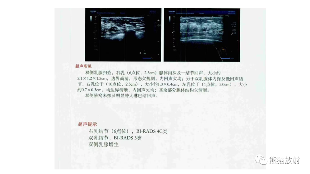 影像PPT - 【病例】乳腺粘液癌2例MR影像-3