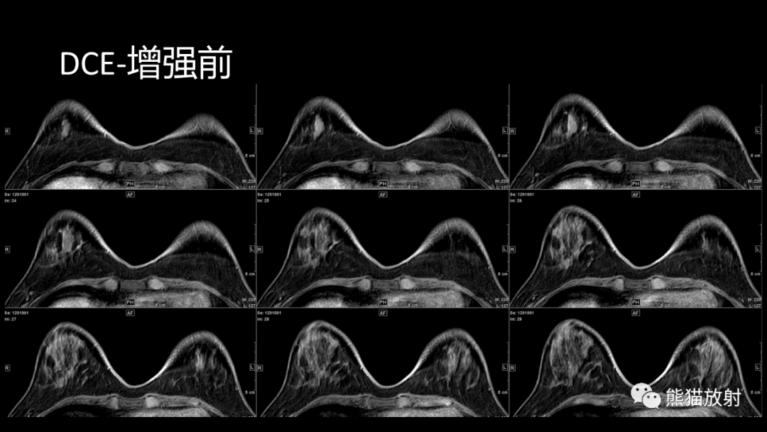 影像PPT - 【病例】乳腺粘液癌2例MR影像-5